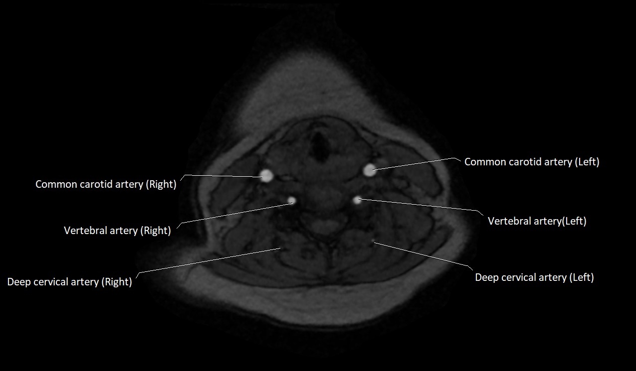 Carotid artery anatomy axial 3T image 41.jpg
